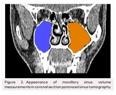 Does Nasal Septum Deviation with Different Locations and Different Angular Features Affect Maxillary Sinus Volumes?