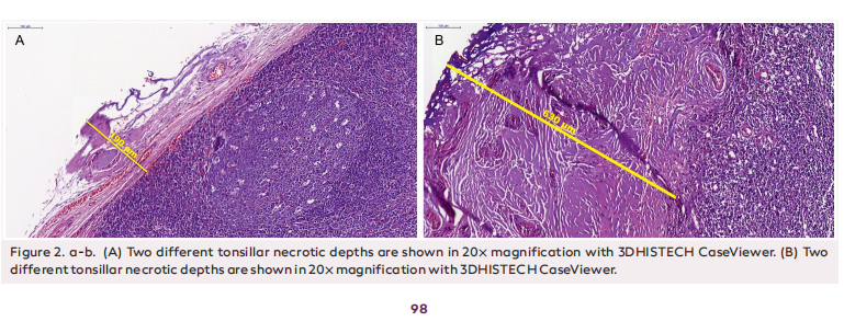 Comparison of Two Techniques in Pediatric Tonsillectomy: Erbe Unipolar Electrocautery and Thermal Welding System