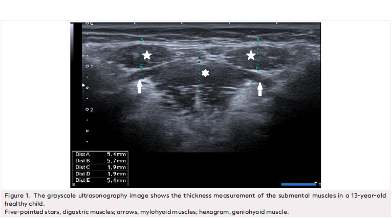 Measurement of the Thickness of Submental Muscles by Ultrasonography in Healthy Children