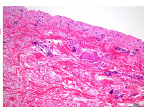 Immune-related adverse events caused by combined immune checkpoint inhibitor therapy with nivolumab and ipilimumab for lung cancer