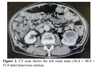 Durable complete response to combination nivolumab and ipilimumab in metastatic renal cell carcinoma