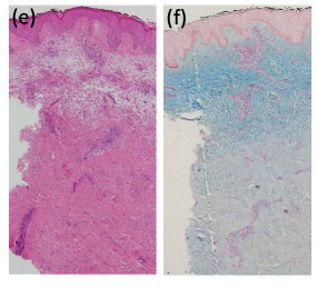 Pretibial myxedema exhibiting prominent asymmetrical manifestations