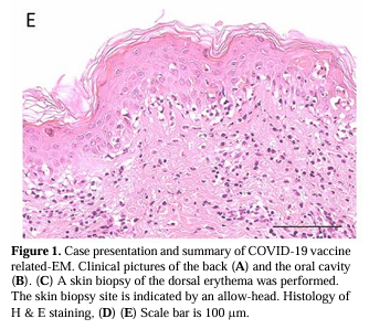 Summary of COVID-19 vaccine-related erythema multiforme at Kindai University Hospital, Japan