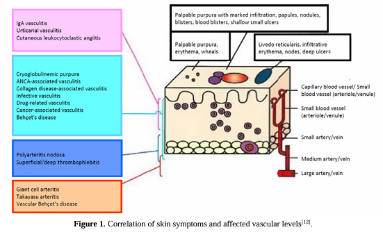 The concise review of etiology, pathology, and treatment strategy of polyarteritis nodosa
