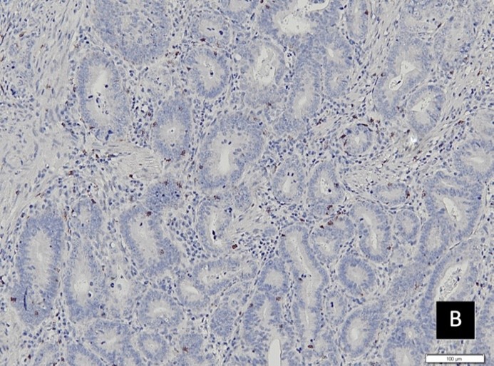 Intra‐tumoral tumor infiltrating Lymphocyte‐T CD8+ and chemotherapy response in colorectal cancer: A prospective observational study