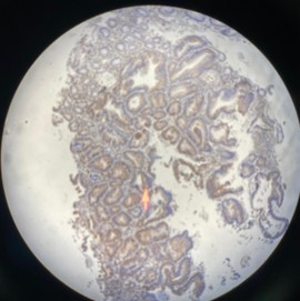 The expression of autophagy-associated protein LC3, metastasis, and chemotherapy response in colorectal cancer patients receiving uracil-based chemotherapy: An observational study
