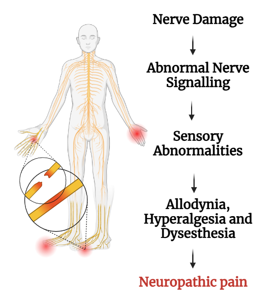 Mechanism and Preclinical Models of Neuropathic Pain: An Update